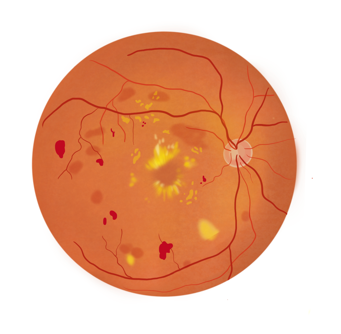 Visuel de rétinopathie diabétique