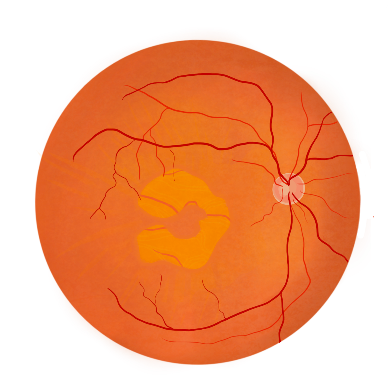 Schéma d'un fond de l'œil avec l'apparition de la DMLA